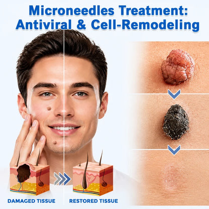 Flawless skin in 5 days – painless removal of skin tags, moles, and warts.