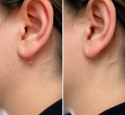 Flawless skin in 5 days – painless removal of skin tags, moles, and warts.