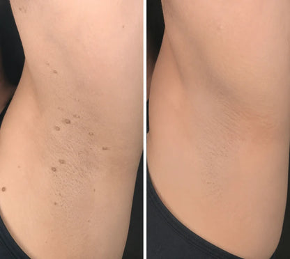Flawless skin in 5 days – painless removal of skin tags, moles, and warts.