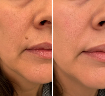 Flawless skin in 5 days – painless removal of skin tags, moles, and warts.