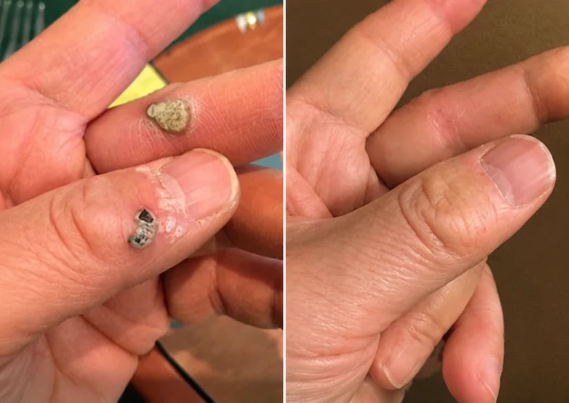 Flawless skin in 5 days – painless removal of skin tags, moles, and warts.